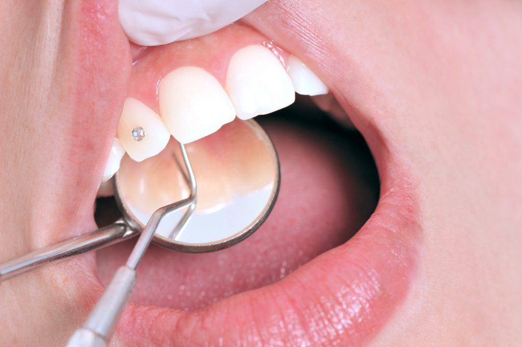 Grills dentales: riesgos y recomendaciones